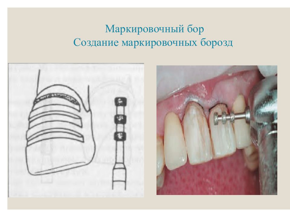 Препарирование под виниры схема