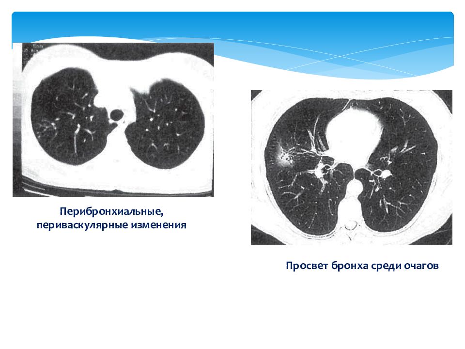 Очаги на кт легких форум. Перибронхиальная инфильтрация легких что это такое. Очаг звездчатого фиброза на кт. Перибронхиальные очаги на кт. Перибронхиальная пневмония кт.