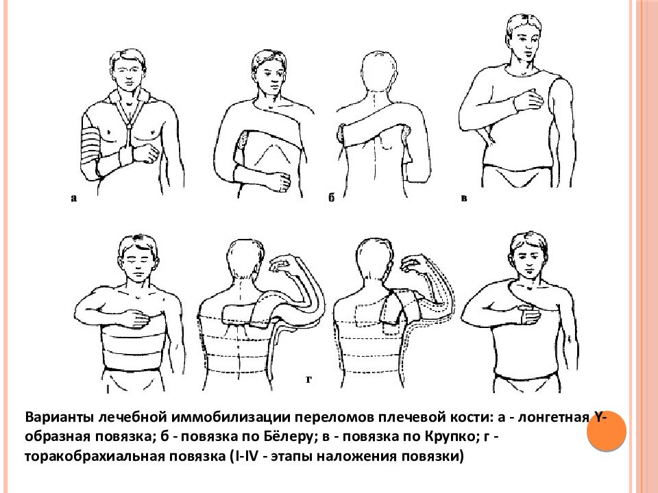 Повреждения плечевого пояса презентация