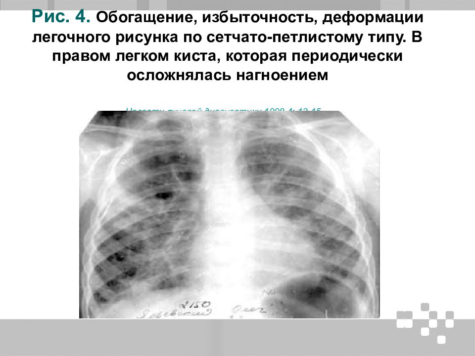 Сосудистый рисунок обогащен в легких что это значит