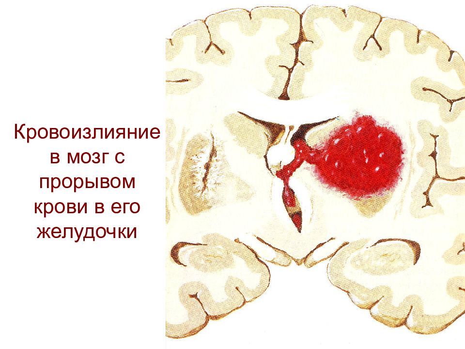 Острые нарушения мозгового кровообращения презентация