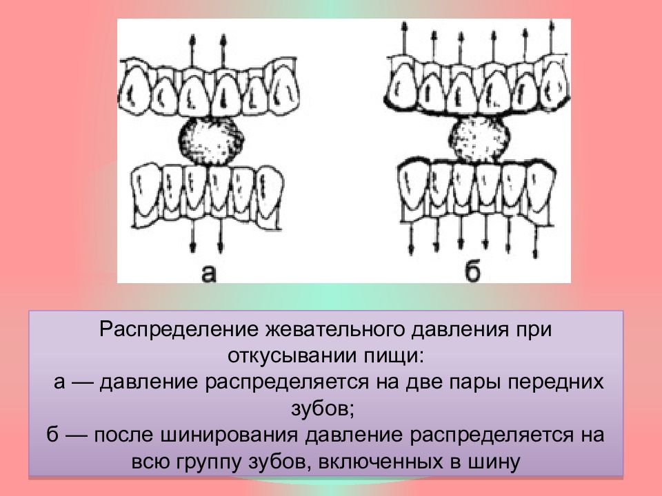 Постоянное шинирование при заболеваниях пародонта презентация