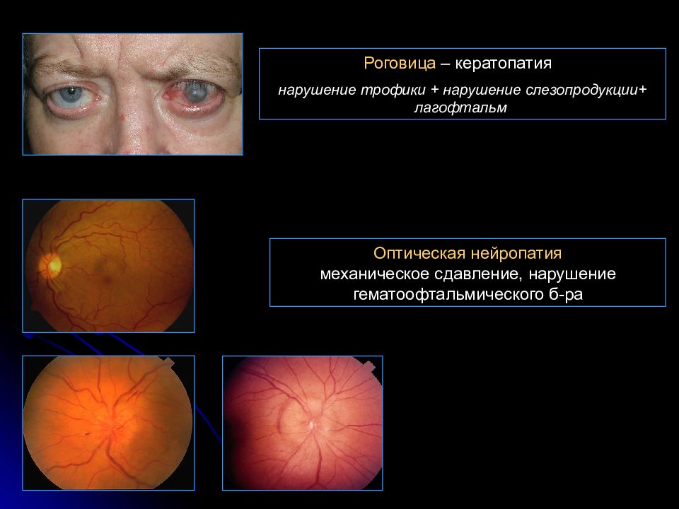 Нарушение тканей. Нарушение нервной трофики. Нейротрофическая кератопатия. Оптическая нейропатия.