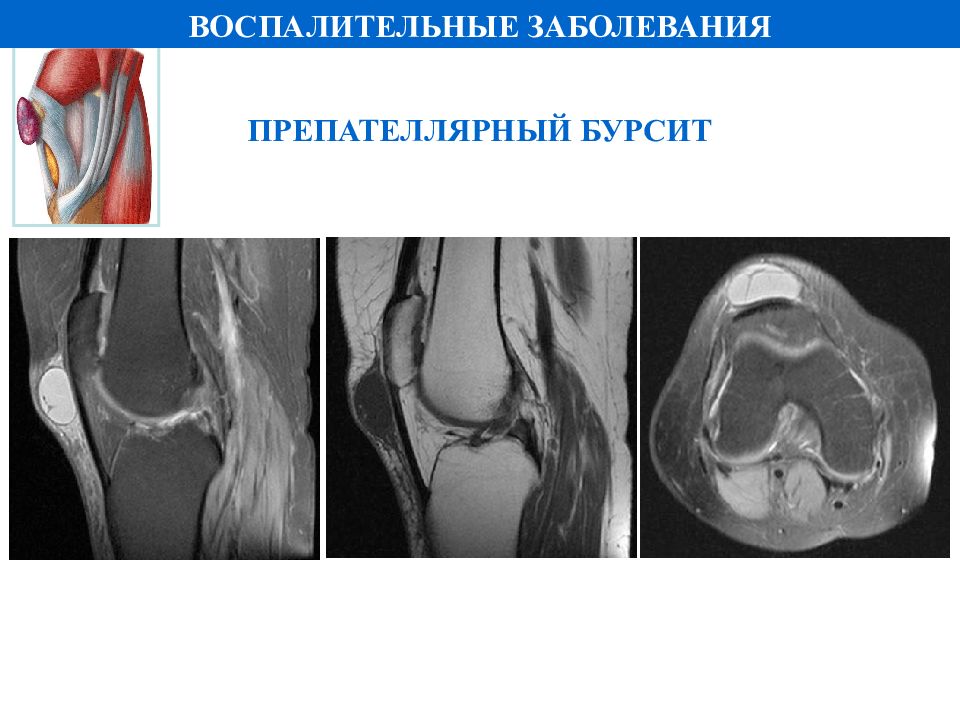 Препателярный бурсит. Препателлярный бурсит. Ретропателлярный бурсит. Анзериновый бурсит мрт. Препателлярный бурсит мрт.