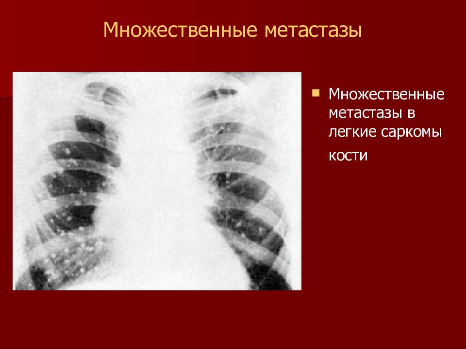 Метастазы в легких это. Множественные метастазы в легких. Множественные метастазы в легкие. Рентгенодиагностика опухолей легких.