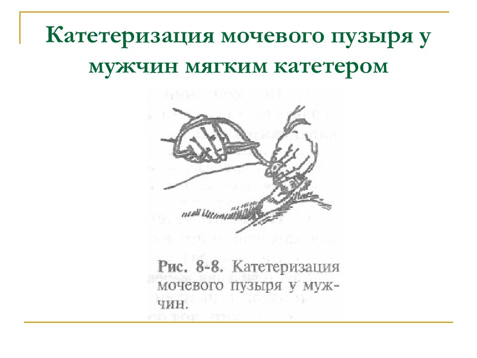 Катетеризация мочевого пузыря виды катетеров. Катетеризация мочевого пузыря. Катетеризация мочевого пузыря алгоритм выполнения Сестринское дело. Катетеризация мочевого пузыря мягким катетером. Катетеризация женщины алгоритм.