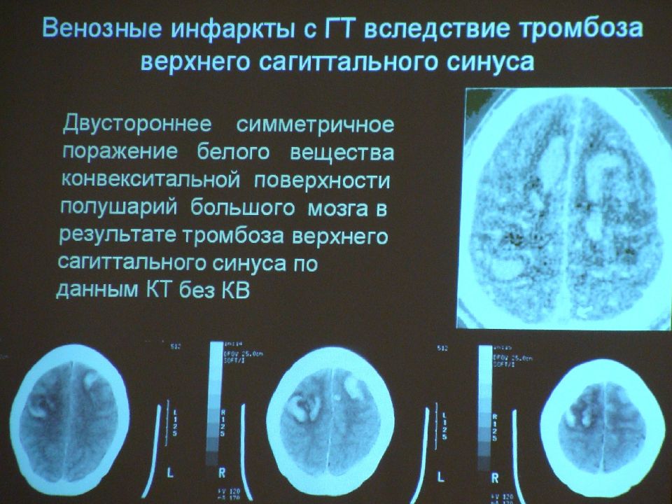 Тромбоз мозговых артерий инфаркт. Венозный инфаркт головного мозга кт. Венозный инсульт кт. Венозный инсульт мрт. Тромбоз синусов головного мозга кт.