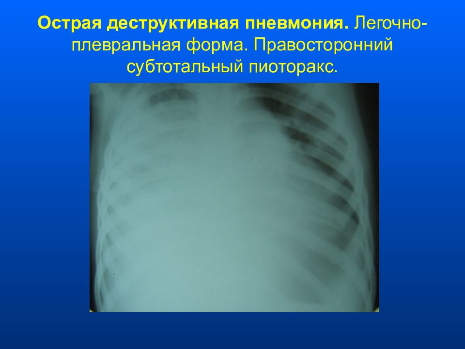 Бактериальная деструкция легких у детей презентация