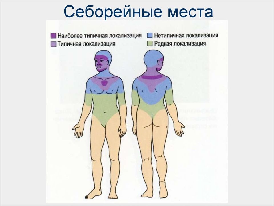 Себорейный дерматит презентация