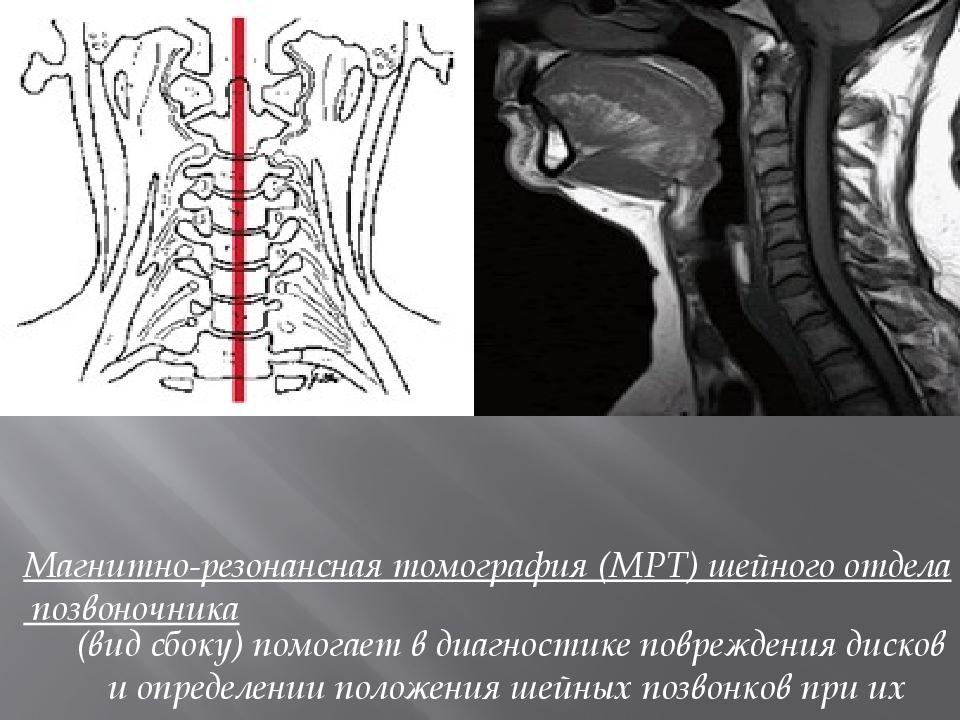 Мрт шейного отдела. Магнито резонансная томография шейного отдела позвоночника. Магниторезонансную томографию шейного отдела позвоночника. Синдромы шейного отдела позвоночника. Смещение шейных позвонков на мрт.