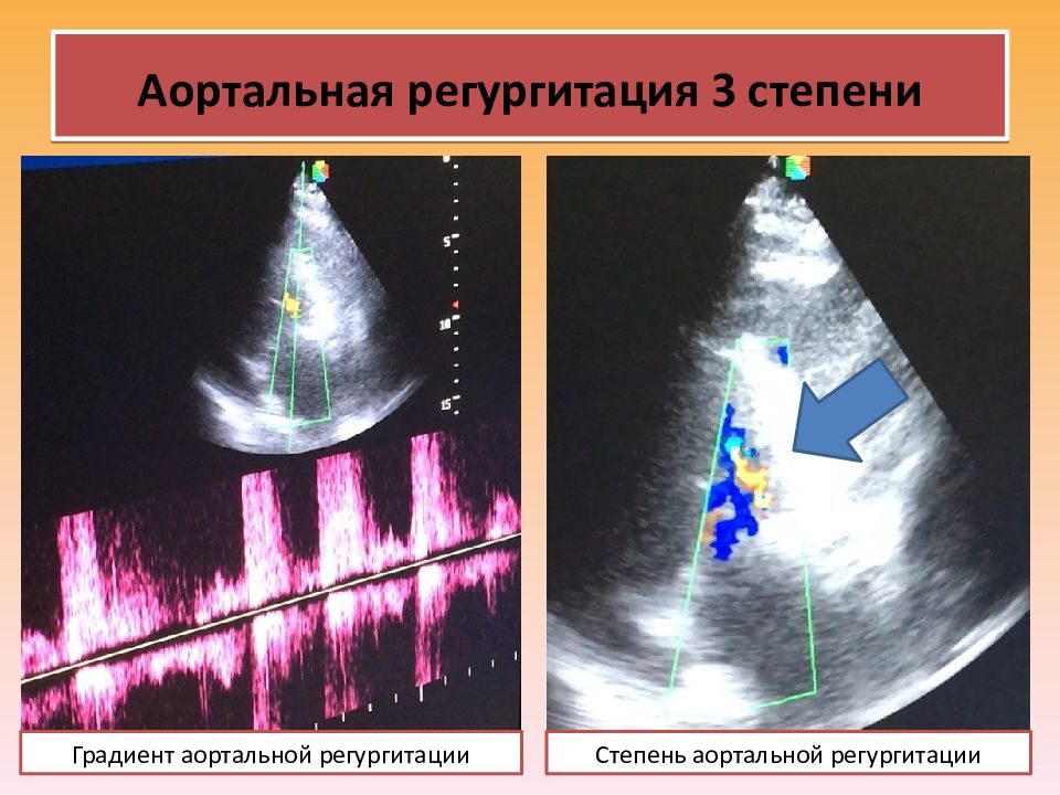 Митральная регургитация 2 степени. Сегменты митрального клапана на ЭХОКГ. Степени митральной регургитации по ЭХОКГ. Аортальная регургитация на ЭХОКГ. Стеноз митрального клапана ЭХОКГ.