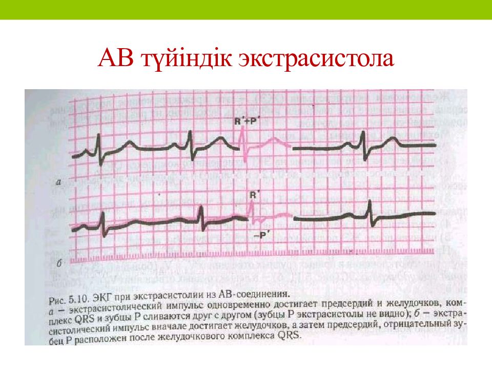 Экстрасистолия на экг. АВ Узловая экстрасистолия на ЭКГ. Стволовые экстрасистолы на ЭКГ. Экстрасистолия АВ узла на ЭКГ. Av Узловая экстрасистолия на ЭКГ.