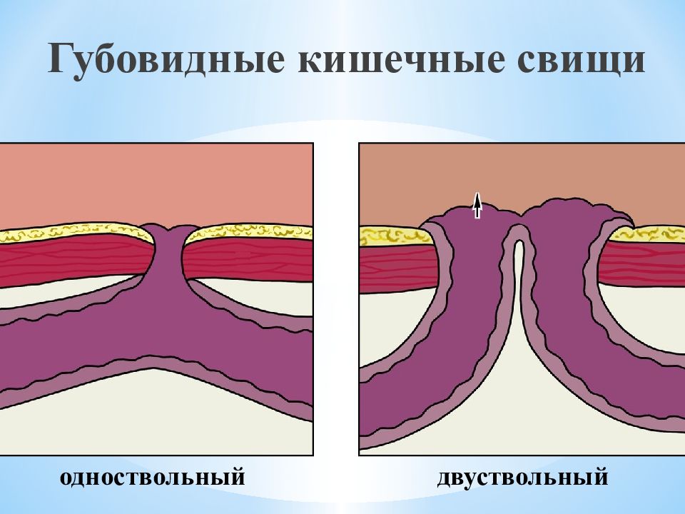 Сформированные свищи. Эпителизированный свищ. Губовидные кишечные свищи.