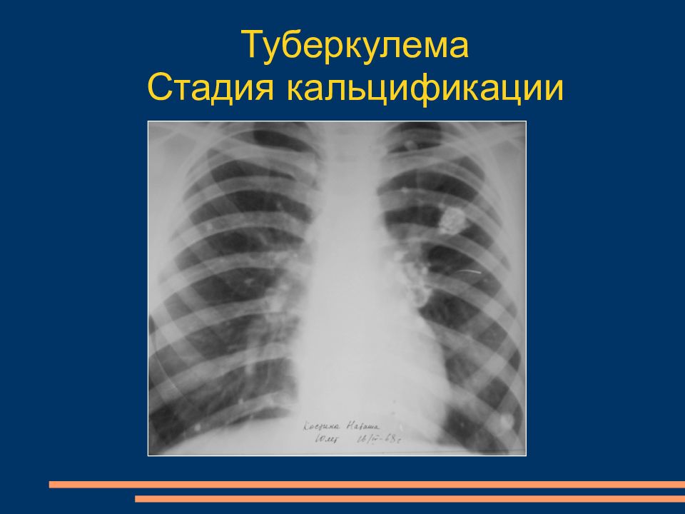 Туберкулема. Туберкулема легкого рентген. Туберкулема на рентгенограмме. Туберкулема легких рентген признаки.