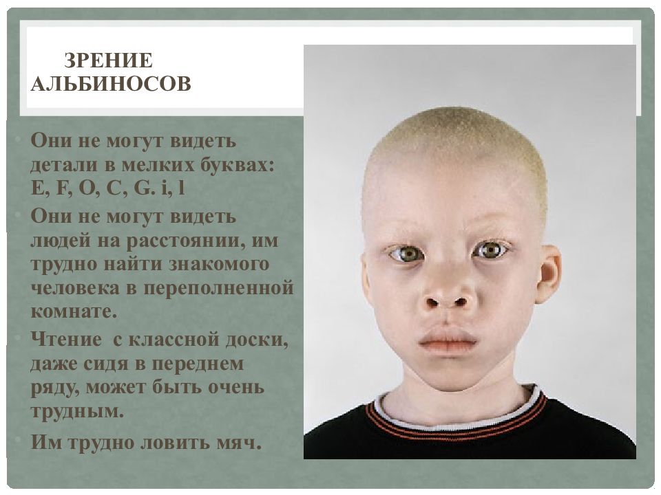 Как люди рождаются альбиносами. Глазокожный альбинизм Тип 1а. Глазокожный альбинизм 4 типа. Альбинизм наследственное заболевание. Альбинизм у детей.
