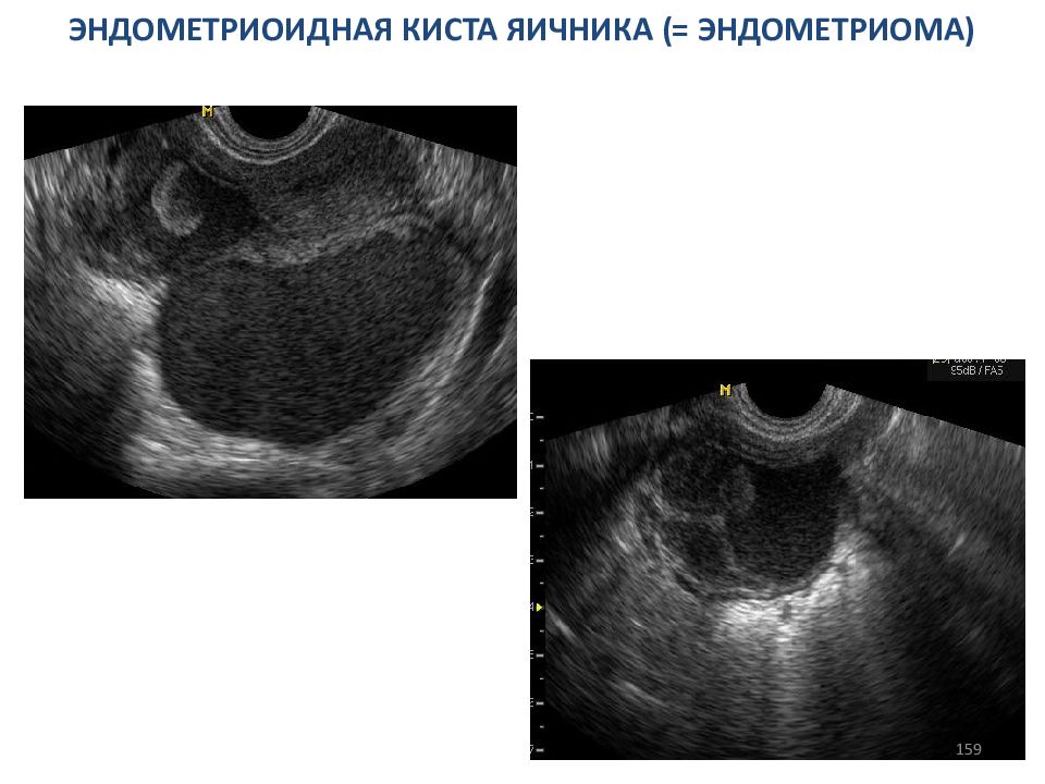 Эндометриозная киста. Эндометриома яичника на УЗИ. Киста левого яичника эндометриома. Эндометриоидная киста яичника на УЗИ. Шоколадная киста яичника УЗИ.