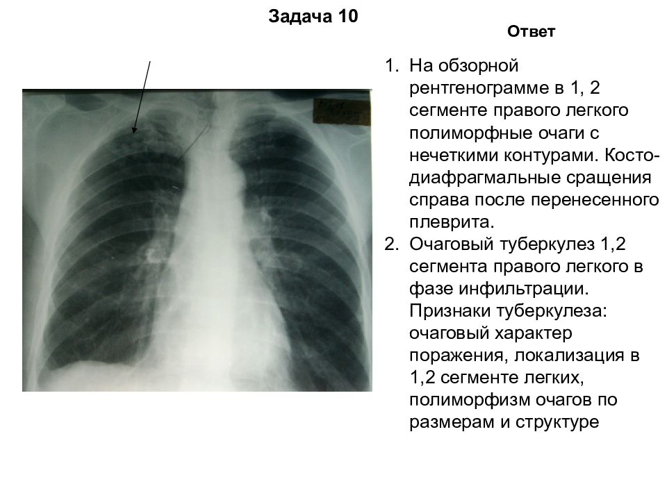 Легочный рисунок усилен кальцинаты в корнях