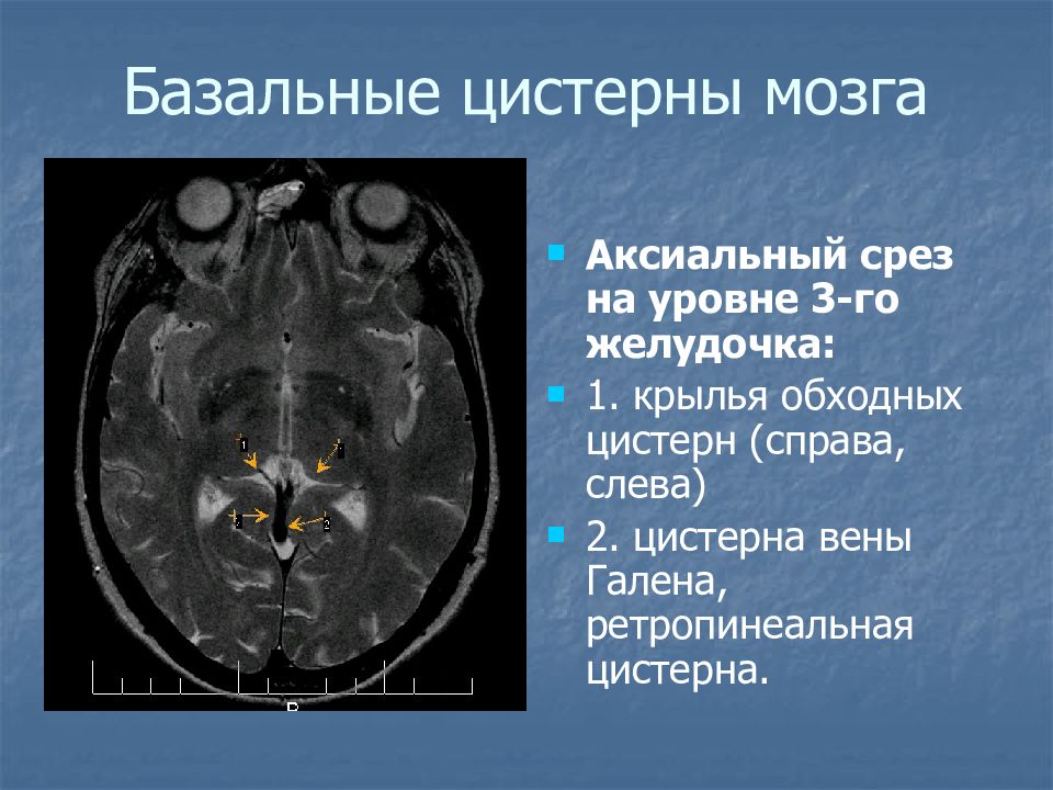 Цистерны мозга расширены. Цистерна вены Галена кт. Киста цистерны вены Галена мрт. Цистерны мозга кт анатомия. Расширение Вена Галена на мрт.