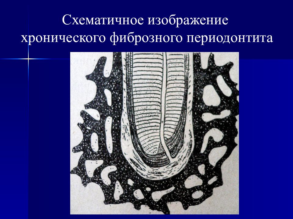 Фиброзный периодонтит. Хронический фиброзный пародонтит. Хронический фиброзный периодонтит. Хронический фиброзный верхушечный периодонтит.. Хронический фиброзный периодонтит этиология.