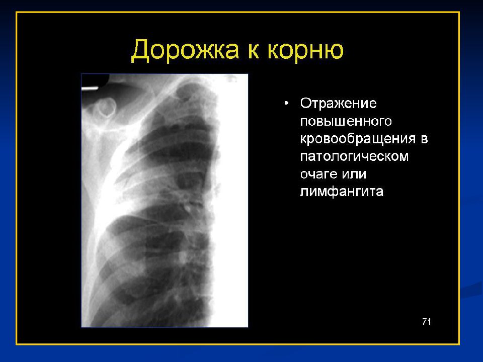 Дорожка корень. Бронхиальная дорожка к корню легкого. Дорожка к корню легкого на рентгене. Очаг с дорожкой к корню легкого. Дорожка к корню легкого при туберкулезе.