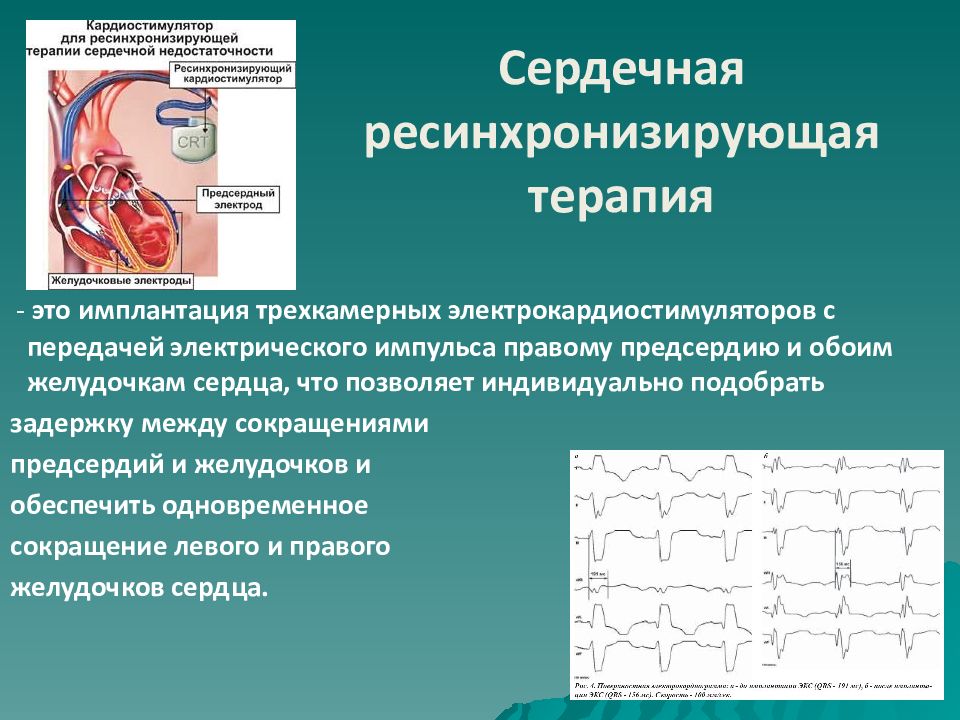 Ресинхронизирующая терапия презентация