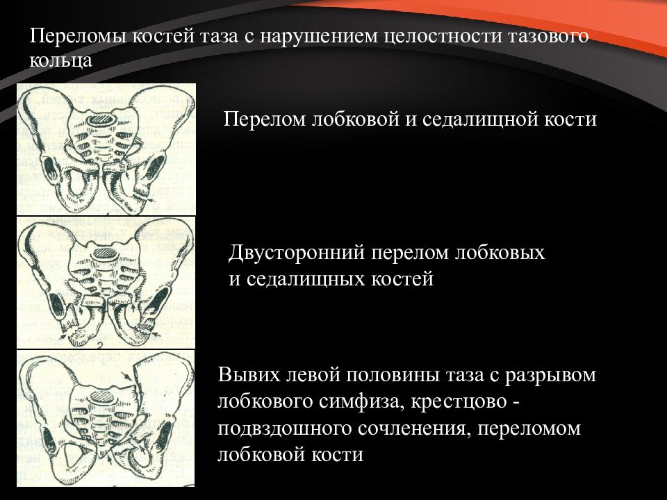 Перелом костей таза карта вызова