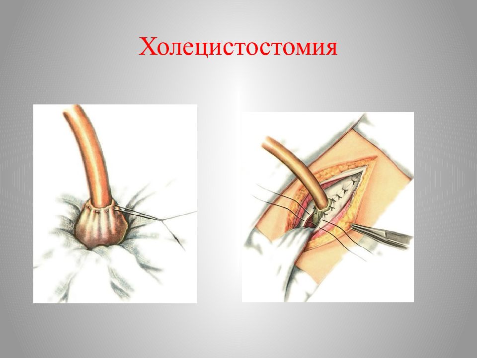 Холецистостомия, холецистэктомия, холедохотомия. Холецистостомия дренаж. Холецистостомия техника показания. Холецистостомия техника операции.