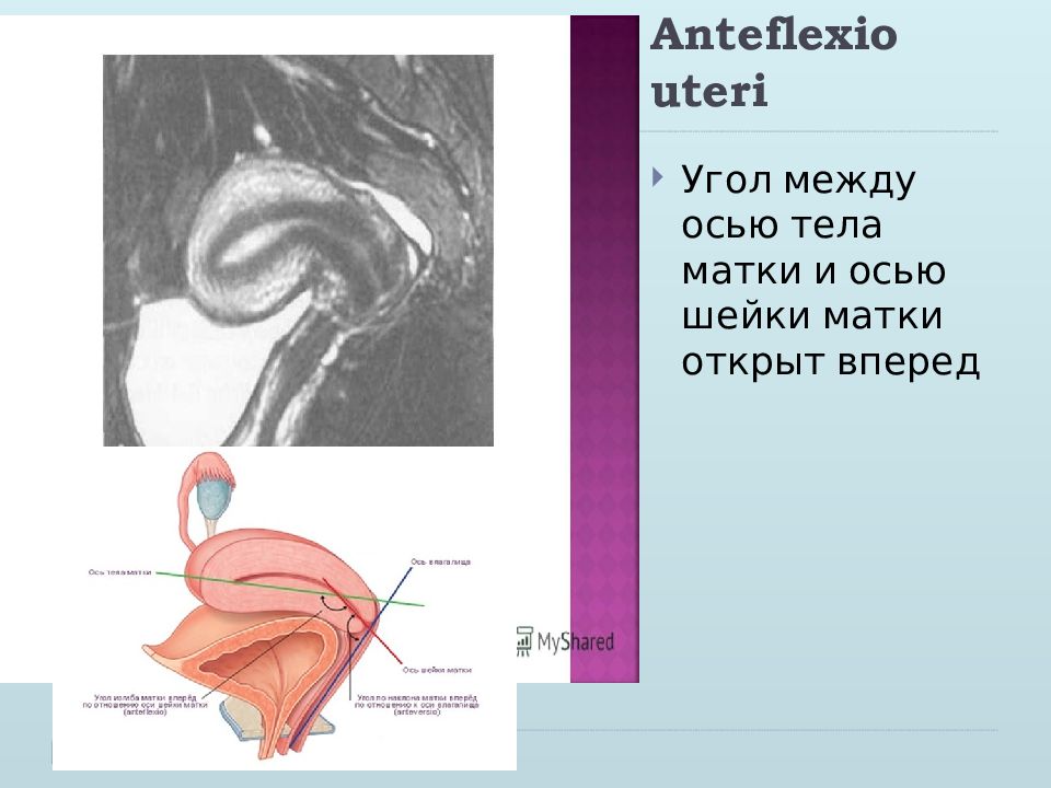 Положение тела матки. Антеверзио антефлексио. Anteflexio матка. Матка расположена в anteflexio что это. Положение матки anteflexio.