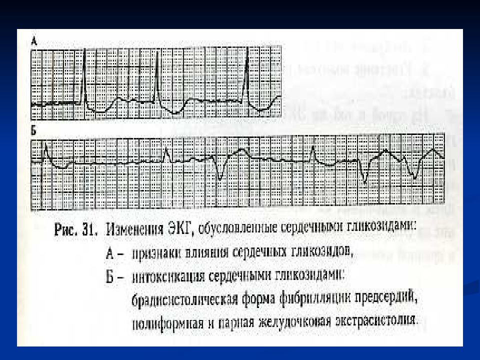 Экг нарушение проводимости. Кроссворд на тему нарушение ритма сердца и проводимости.