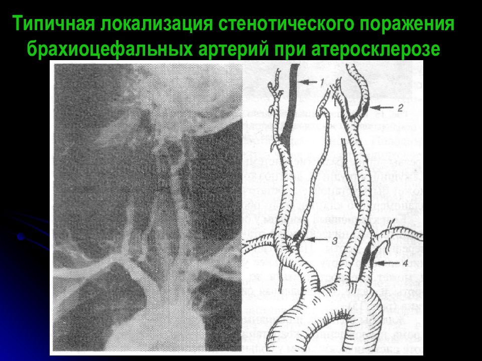 Брахиоцефальные артерии