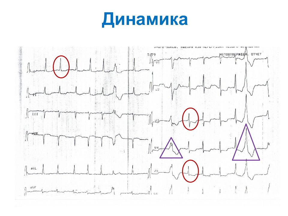 Экг в динамике что это. ЭКГ при гиперкалиемии. Практикум по ЭКГ. Тахисистолическая форма фибрилляции предсердий. Гиперкалийгистия на ЭКГ.