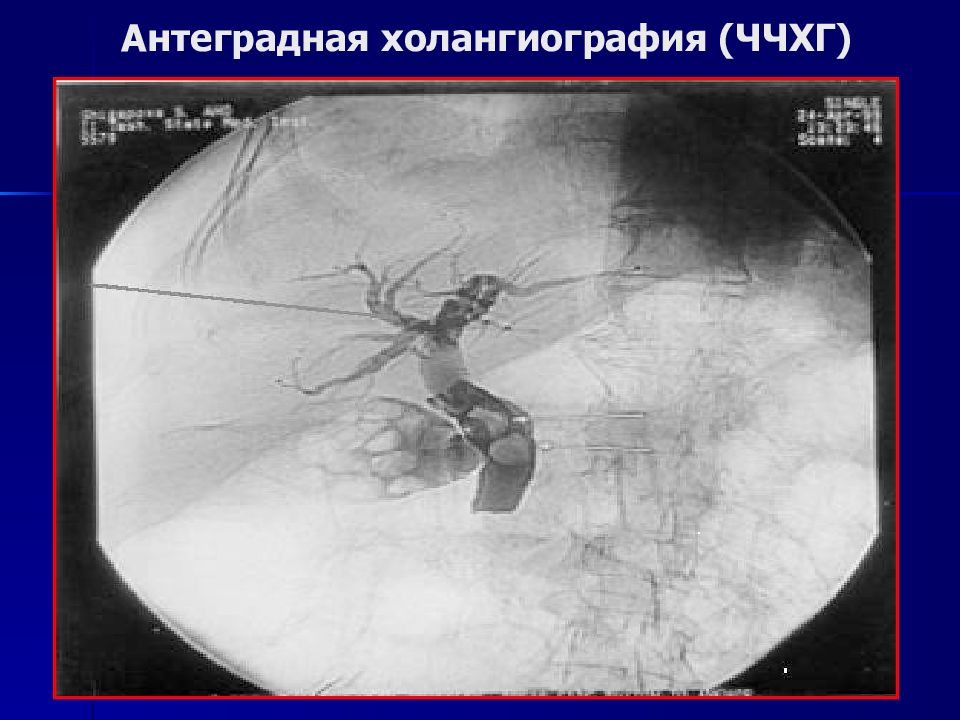 Холангиография. Антеградная холангиография. Транспариетальная холангиография. Чрескожную чреспеченочную холангиографию. Чрескожная чреспеченочная холангиография (ЧЧХГ).