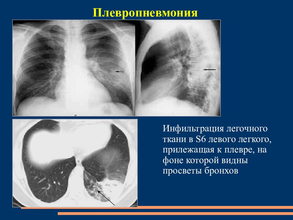 Плевропневмония. Инфильтрация легочной ткани на рентгене. Симптомы плевропневмонии рентген. Инфильтрация легочной ткани на кт. Плевропневмония рентген снимки.