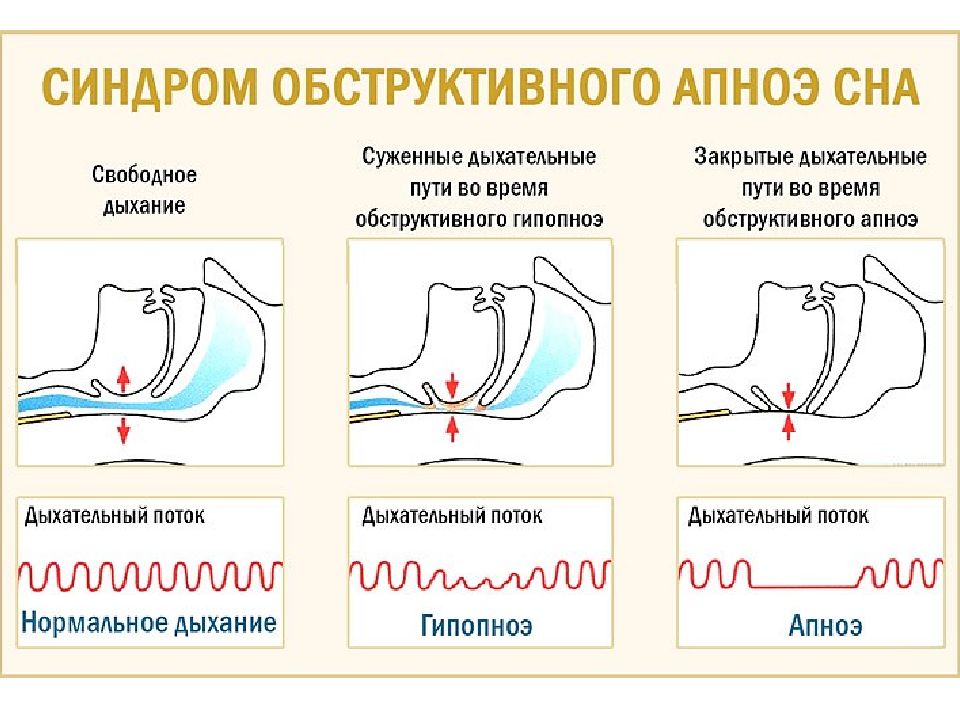 Синдром ночного апноэ презентация