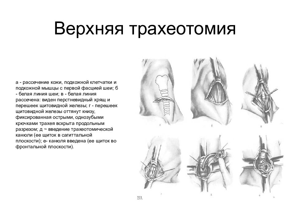 Трахеотомия. Трахеостомия методика. Верхняя срединная трахеотомия. Трахеостомия Оперативная хирургия. Наложение трахеостомы ход операции.