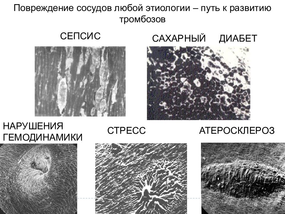 Ранение сосудов. Тромбоз патофизиология.