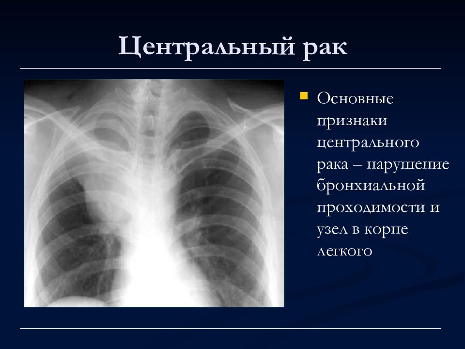 Лучевая диагностика рака легкого презентация