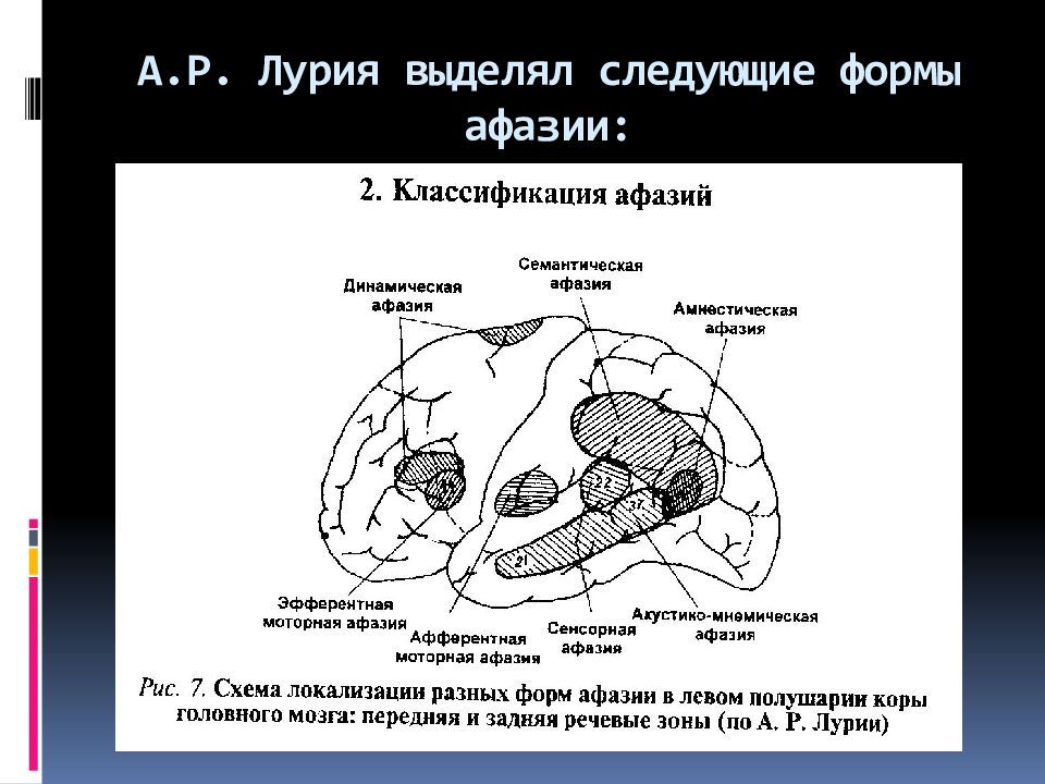 Этиология афазии