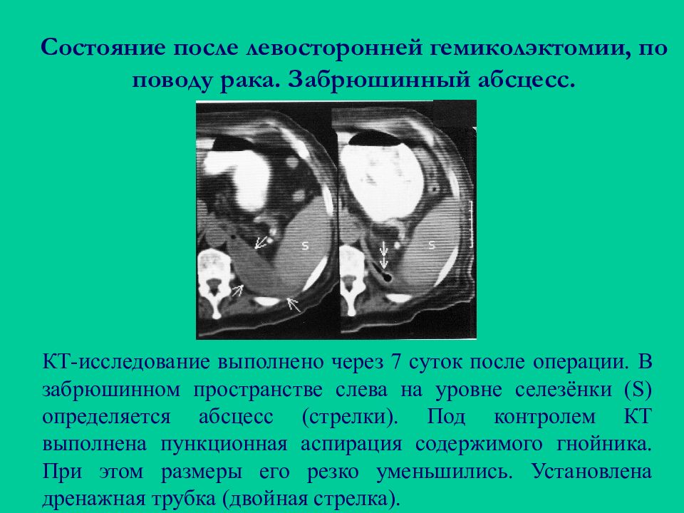 Кт забрюшинного пространства. Забрюшинный абсцесс на кт. Опухоли забрюшинного пространства кт. Киста забрюшинного пространства.