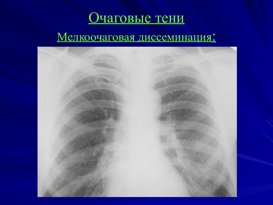 Тени средней интенсивности в легком