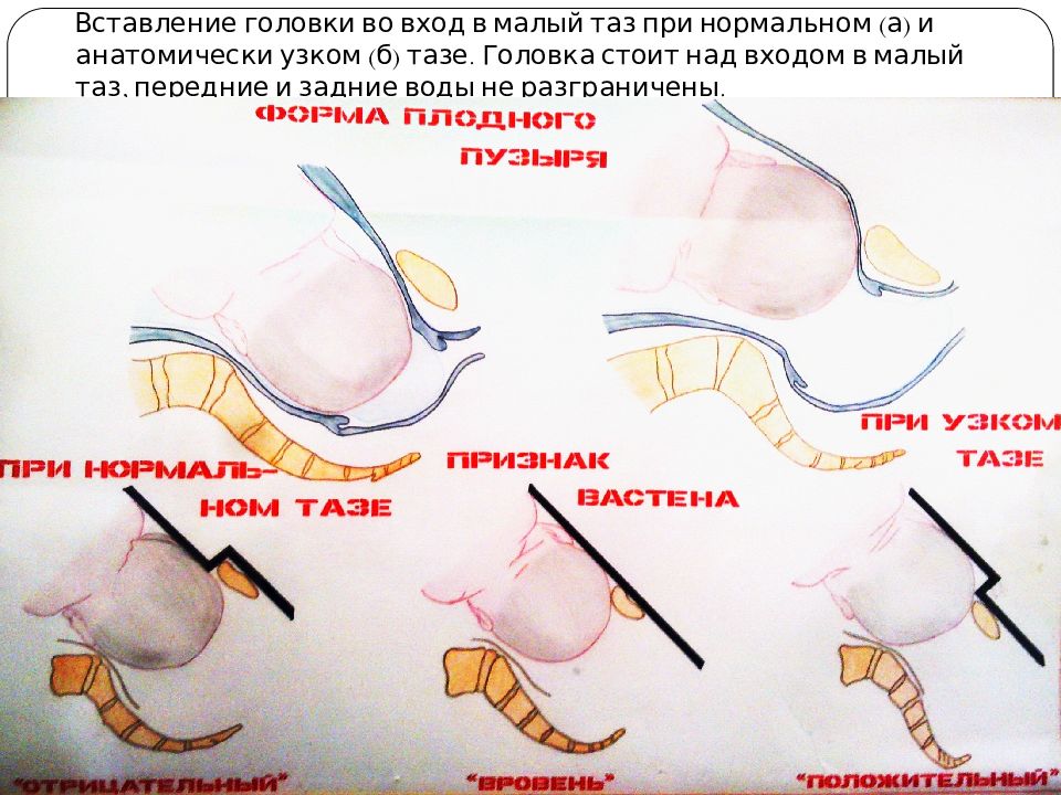 предлежание плода над входом в малый таз. головка над входом в малый. головка над входом в малый. головка над входом в малый. ребенок опустился в таз.