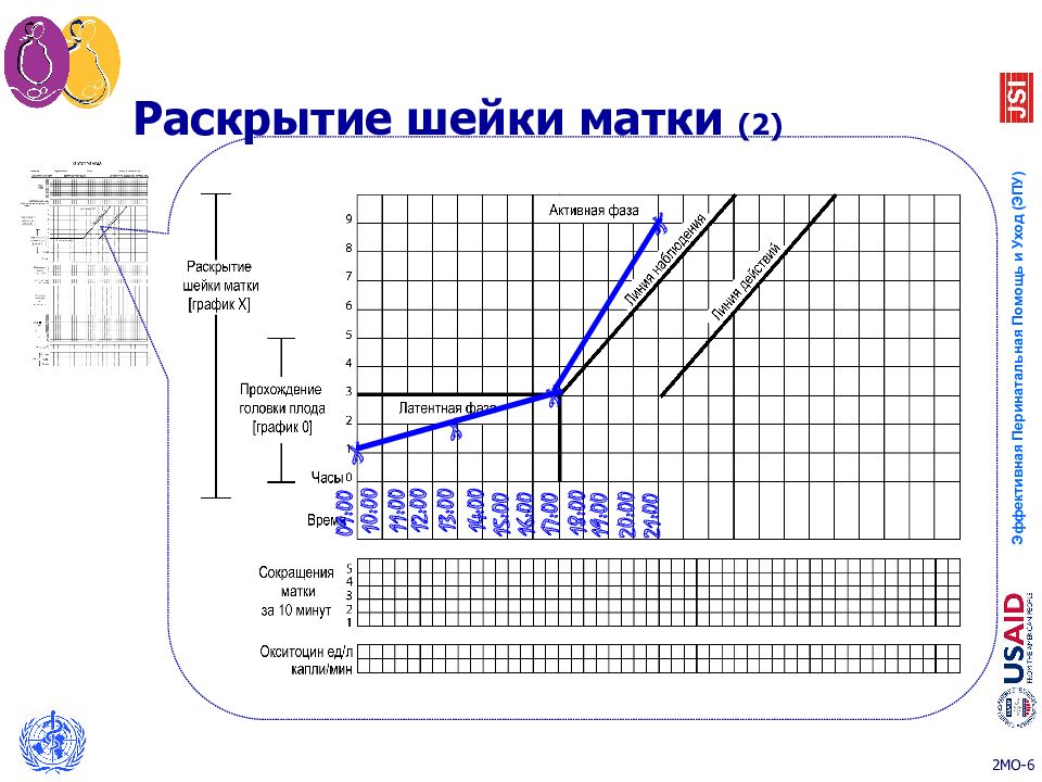 Как понять раскрытие шейки матки. Партограмма раскрытия шейки матки. Дискоординация родовой партограмма. Партограмма при дискоординации родовой деятельности;.