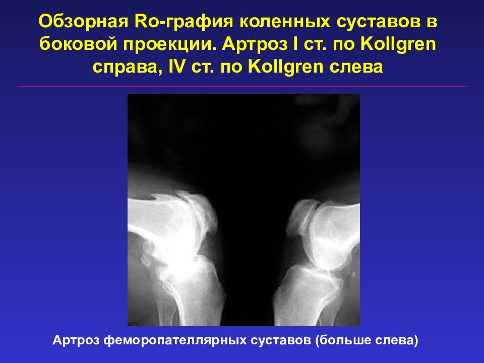 Графия это. РО графия коленного сустава. Артроз в боковой проекции. Артроз феморопателлярного сочленения. Феморопателлярный артроз коленного сустава это.