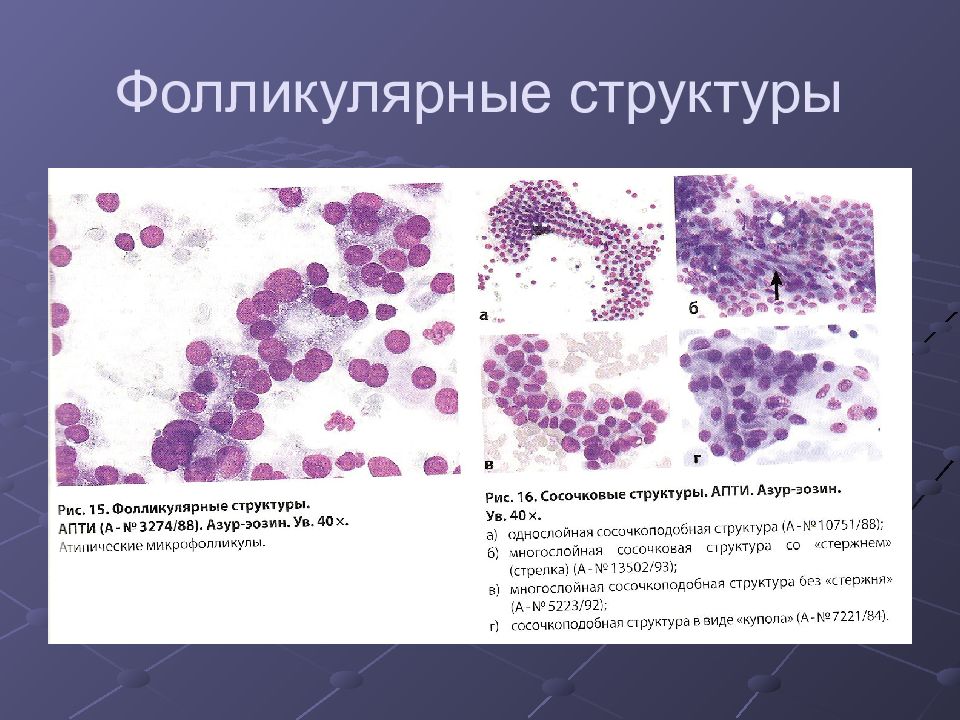 Скопление клеток фолликулярного эпителия. Фолликулярная аденома щитовидной железы цитология. Фолликулярная карцинома щитовидной железы гистология. Цитологическая картина фолликулярной опухоли. Цитологическая картина опухоли щитовидной железы.