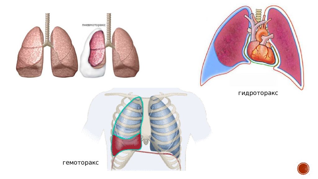 Что такое гидроторакс. Пневмоторакс плевральная жидкость. Пневмоторакс гидроторакс гемоторакс. Осумкованный гемоторакс. Пневмоторакс и гемоторакс.