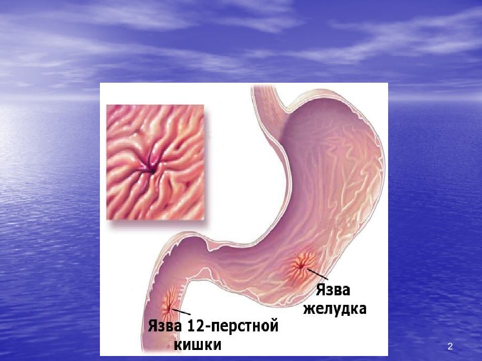 Язва желудка картинки