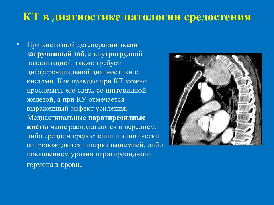При такой патологии как. Внутригрудной и загрудинный зоб. Загрудинный зоб средостения на кт.
