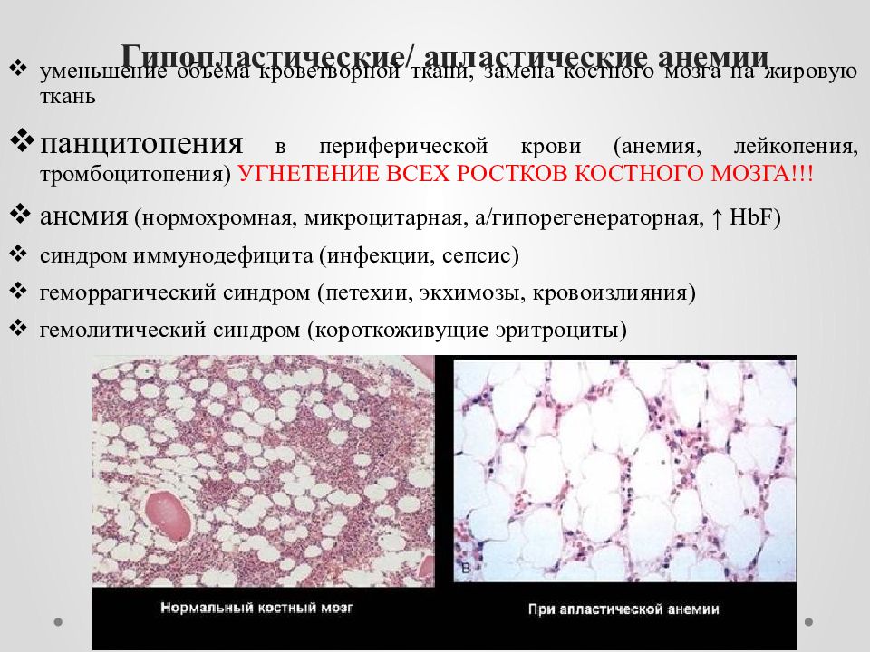 Картина крови при апластической анемии