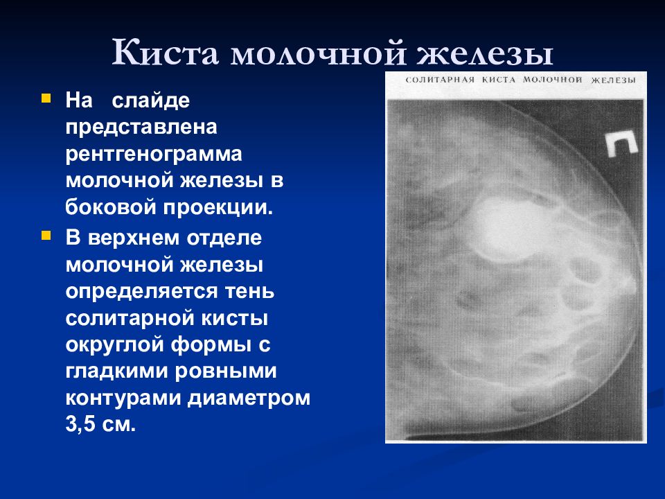 Кисты молочной железы презентация