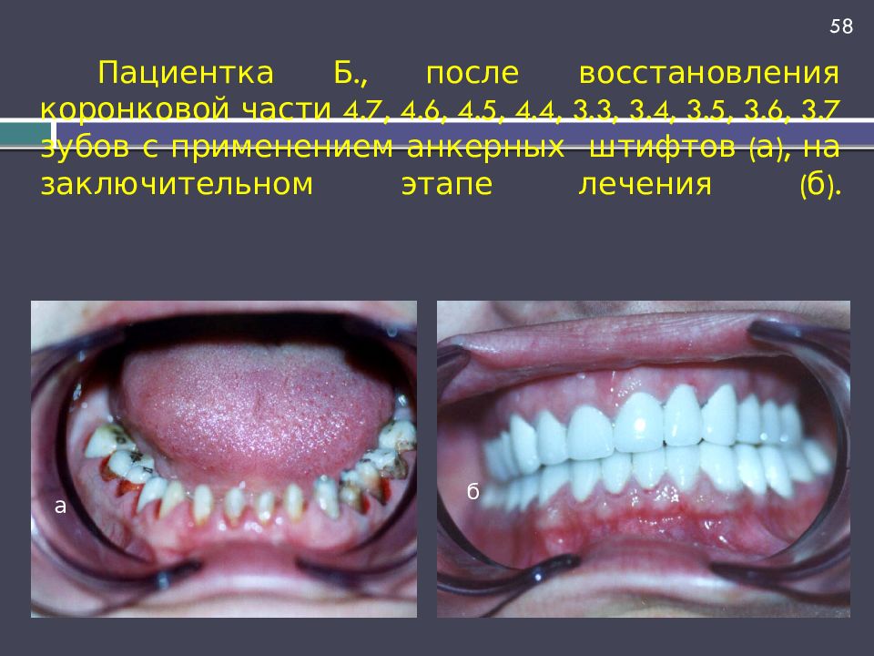 Пациентка Б., после восстановления коронковой части 4.7, 4.6, 4.5, 4.4, 3.3, 3.4, 3.5, 3.6, 3.7 зубов с применением анкерных штифтов (а), на заключительном